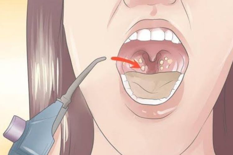 Baca! Ciri-ciri Kalian Memiliki Batu Amandel