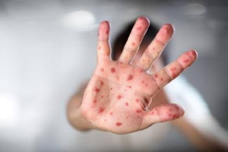AS Dilanda Wabah Campak Terburuk dalam 35 Tahun, Kasus Tembus 2.318 Orang