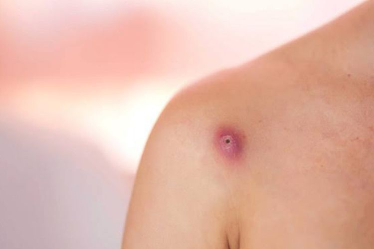 Ini Cara Hilangkan Bisul dengan Cepat Tidak Perluh ke Dokter