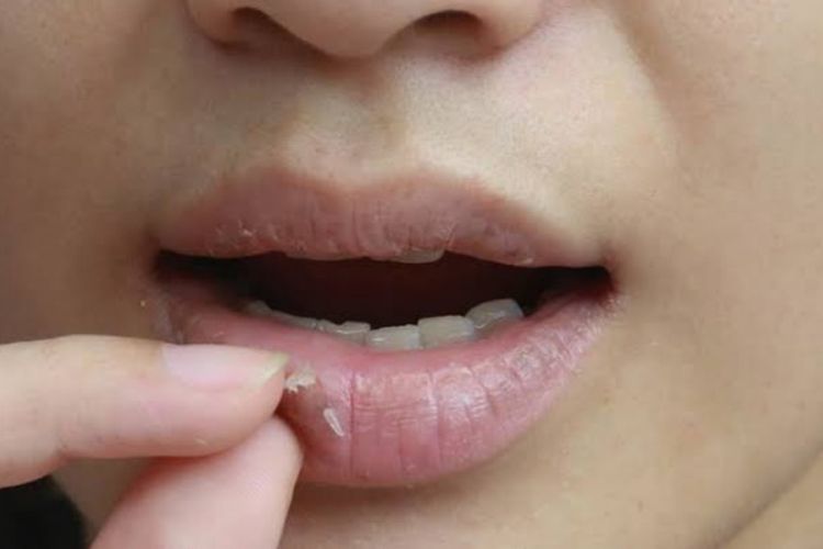 Jangan Dilakukan Lagi! Ini Dampak Berbahaya Mengelupaskan Kulit Bibir