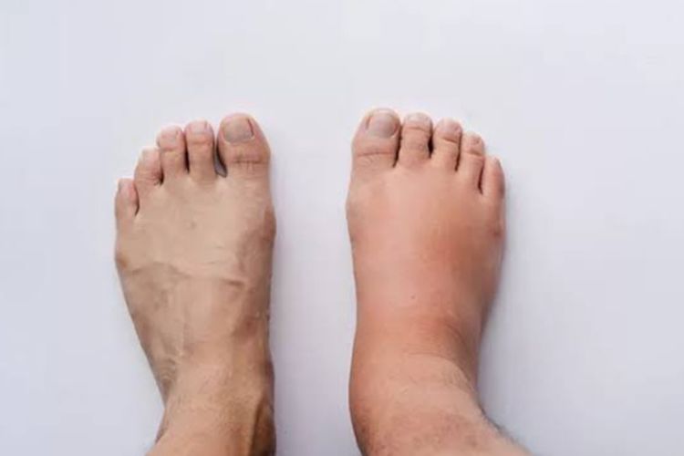 Kalian Harus Tahu! Ini 11 Penyebab Kaki Bengkak