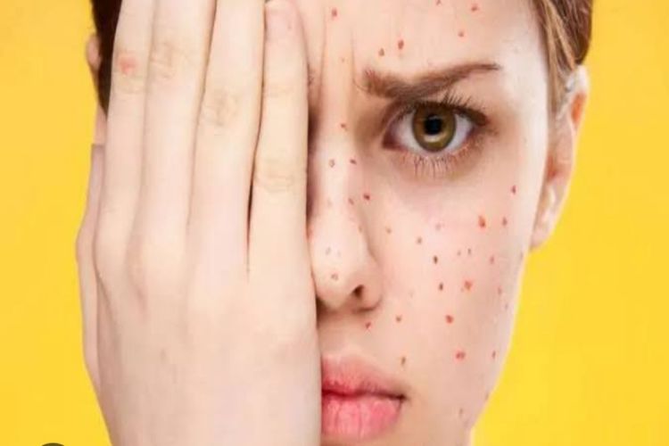 Bikin Malu Seumur Hidup! Ini 10 Cara Hilangkan Bekas Cacar