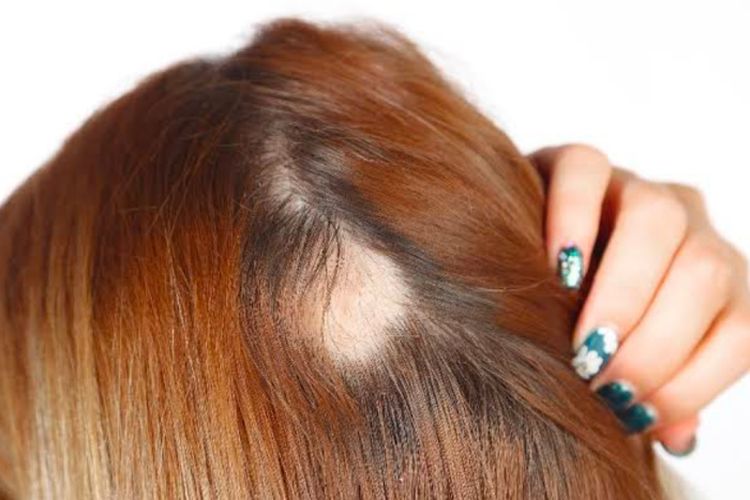 Ini 5 Penyebab Rambut Bisa Pitak